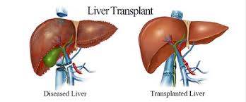 what do you know about kidney transplantation? 