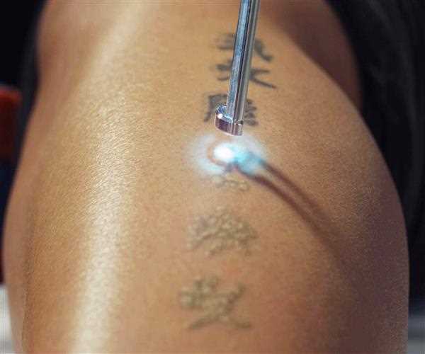 How We can Remove a Permanent Tatoo?