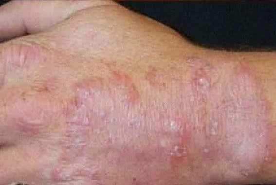 What is the permanent treatment for fungal infection?