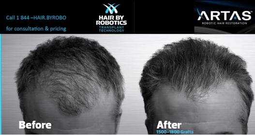 What is best and latest technology hair transplant in India?